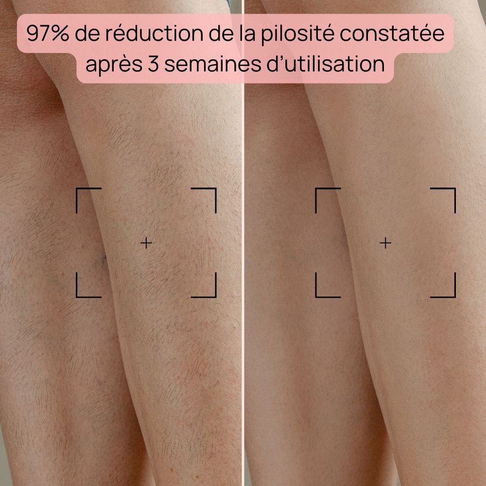epilateur-lumiere-pulsee-resultats-jambes.jpg